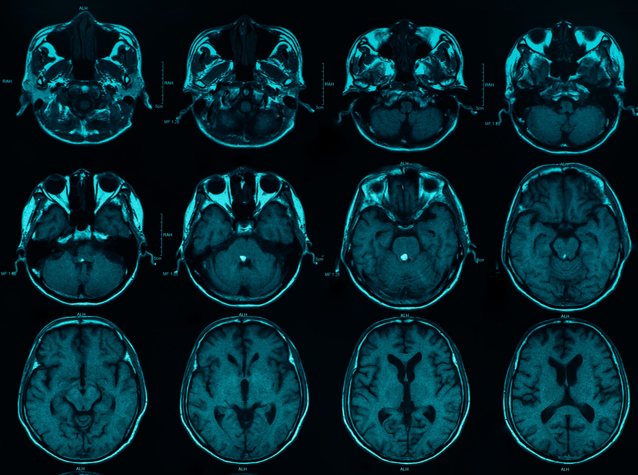 image of CT/MRI brain in blue tone
